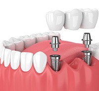 Illustration of dental implant bridge