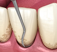 Illustration of scaler cleaning beneath gumline