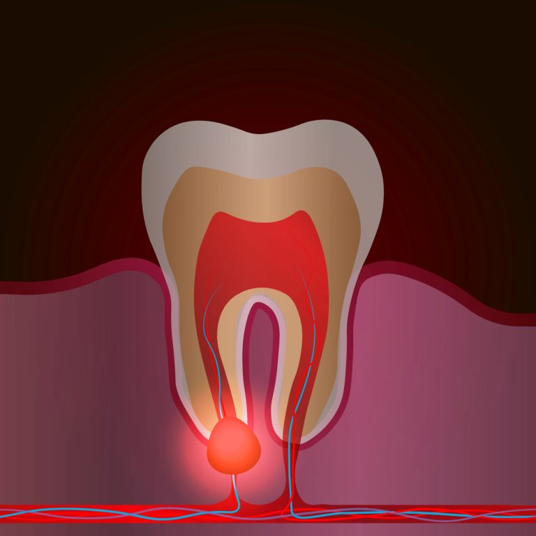 my-toothache-disappeared-what-does-that-mean